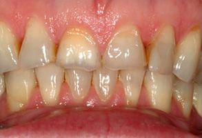 Thomas Dragonette DDS | Dental Bridges, Night Guards and Preventative Program